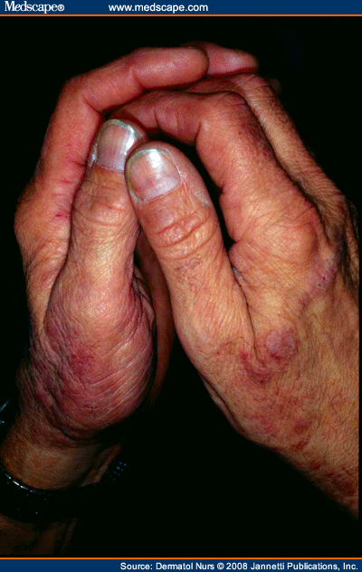 Hand Dermatitis: Clinical Features, Diagnosis, and Management - Page 2