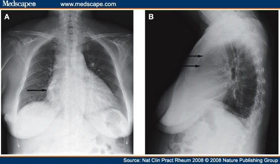 Diagnosing Pulmonary Artery Hypertension in a Woman With Systemic ...