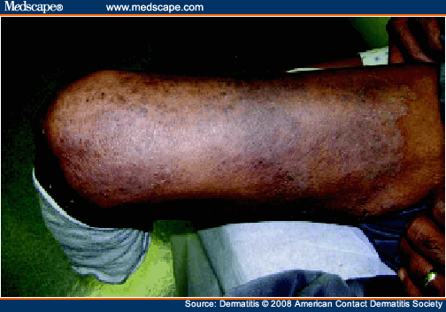 Contact Dermatitis from a Prosthesis - Page 2