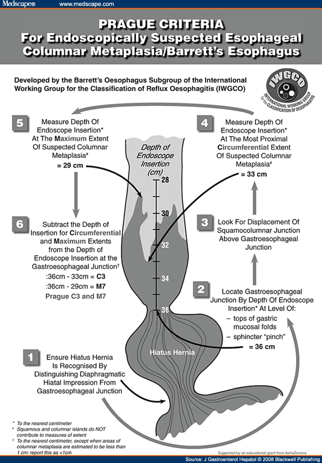Columnar Lined (Barrett's) Esophagus