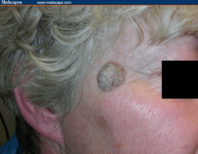 Icd 10 Code For Seborrheic Keratosis Face