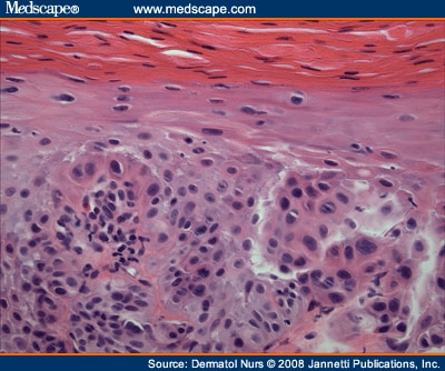 Pseudoepitheliomatous, Keratotic, and Micaceous Balanitis - Page 2