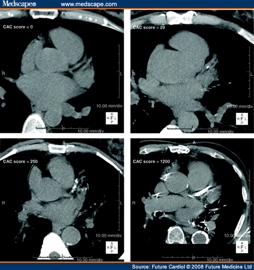 Noninvasive Imaging Using Computed Tomography for Coronary Atherosclerosis