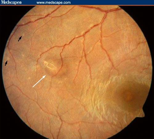 Bilateral Optic Disc Swelling: Presenting Sign of Pheochromocytoma in Child