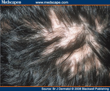 Management of Primary Cicatricial Alopecias