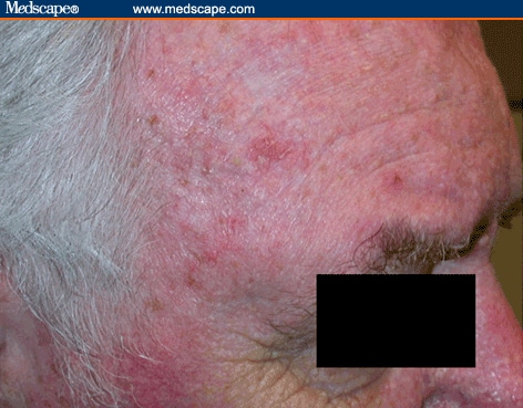 What Do Pathologic Skin Lesions in Elderly Patients Look Like?