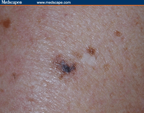 What Do Pathologic Skin Lesions in Elderly Patients Look Like?