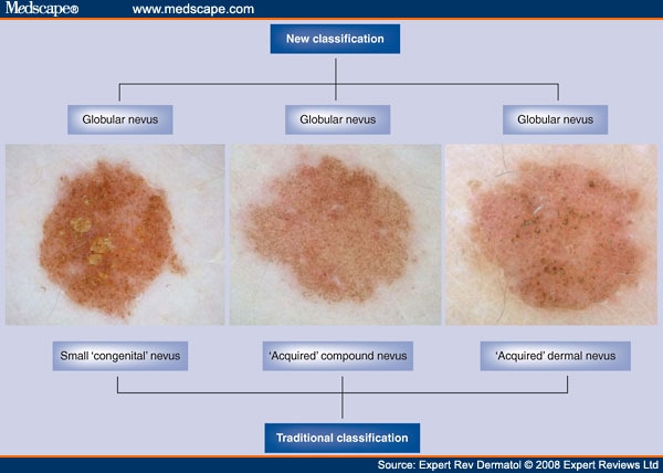 New Classification of Melanocytic Nevi Based on Dermoscopy