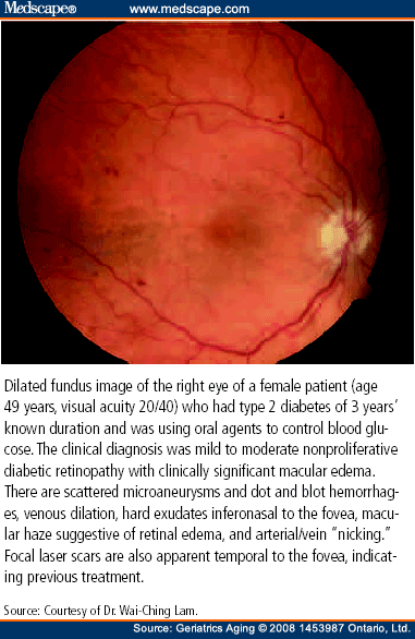 A Clinical Perspective of Diabetic Retinopathy