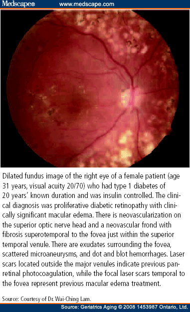 A Clinical Perspective of Diabetic Retinopathy