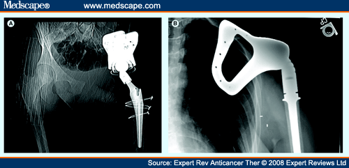 Current Concepts On The Surgical And Medical Management Of Osteosarcoma ...