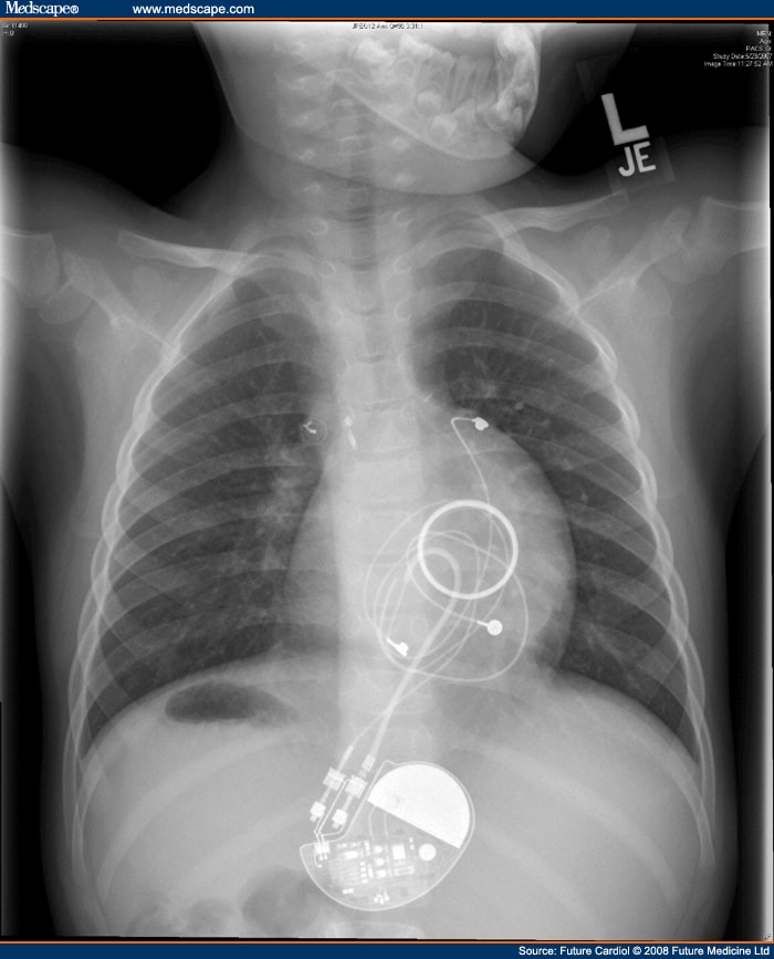 pacemaker-and-defibrillator-therapy-in-peds-and-congenital-heart-disease