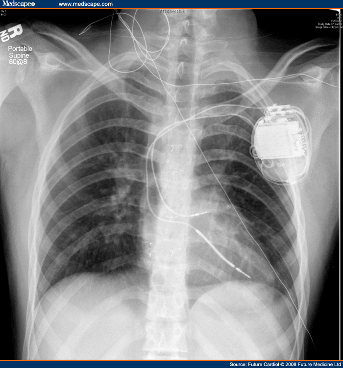 Pacemaker and Defibrillator Therapy in Peds and Congenital Heart Disease