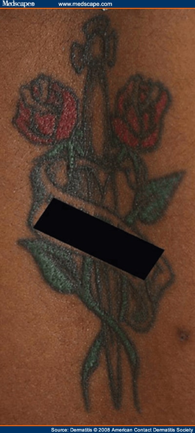 Tattooassociated skin reactions  DermNet