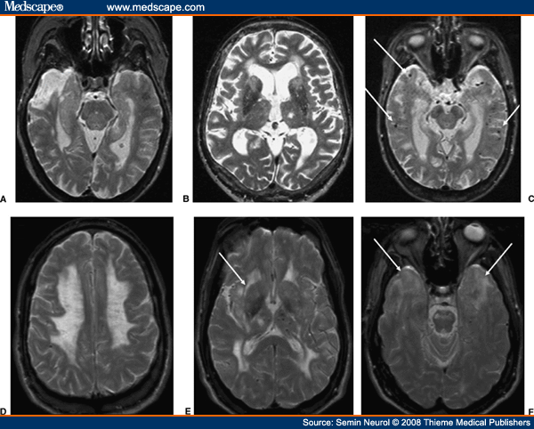 Neuroimaging in Dementia