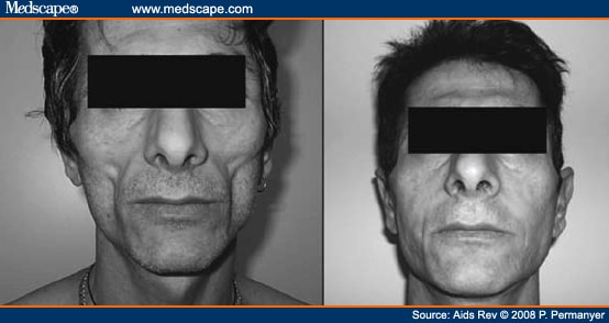 Lipodystrophy and Quality of Life of HIV-Infected Persons
