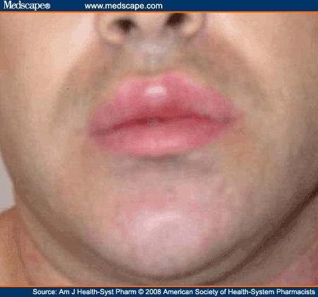Swelling can lorazepam of lips cause