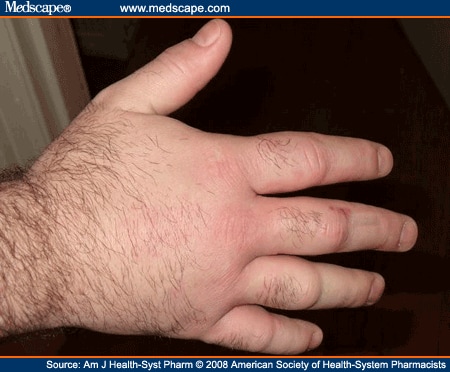 bupropion rash