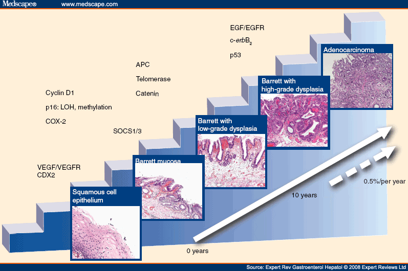 Barrett's Esophagus Can Biomarkers Predict Progression to Malignancy?
