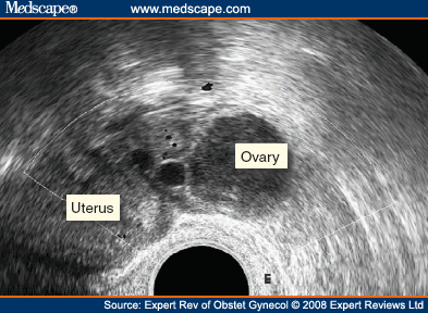 Transvaginal Ultrasonography in Diagnosis of Extrauterine Pelvic ...