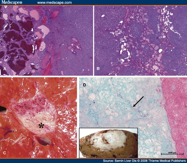 Benign and Malignant Vascular Tumors of the Liver in Adults Page 2