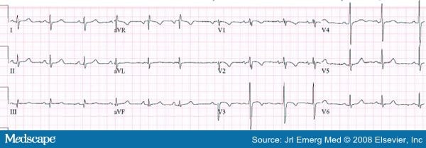 Electrocardiographic Manifestations: Pediatric ECG