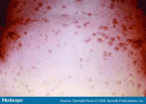 Nurse Practitioner's Guide, Herpes Simplex Virus-1 in Children