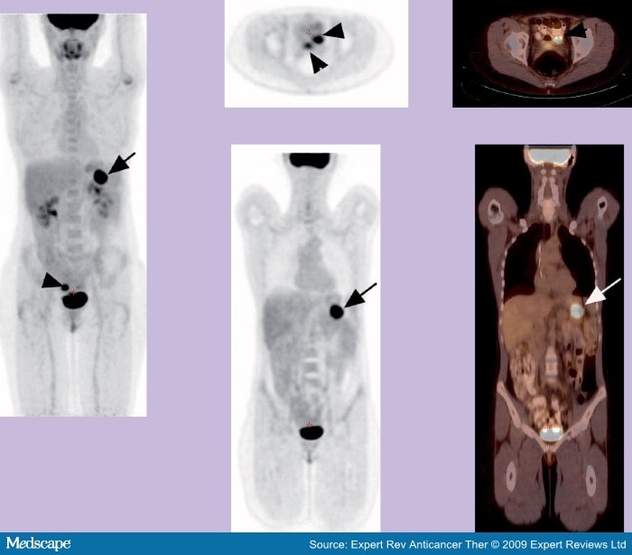 PET and PET-CT Imaging of Gynecological Malignancies: Present and ...