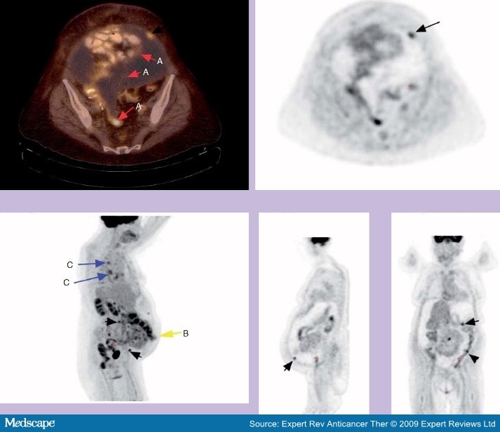 PET and PET-CT Imaging of Gynecological Malignancies: Present and ...
