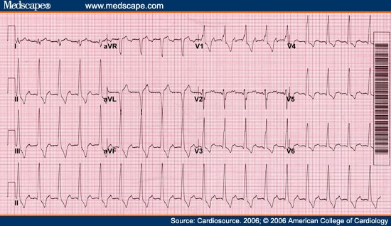 ECG of the Month: Syncope, AV Block