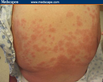 Bullae Back Multiple Tense Bullae on the Trunk and Extremities of an Elderly Man
