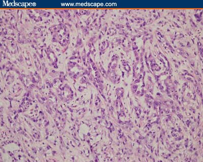 A 90-Year-Old Woman With an Episode of Hematuria and a 66-Year-Old ...