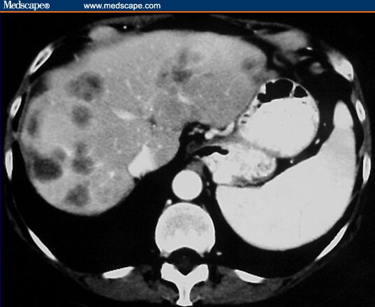 Optimizing Treatment for an Older Patient With Advanced Colon Cancer