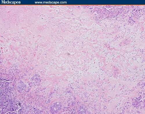 2 Cases: Headache, Nausea, Vomiting; Pulmonary Nodules