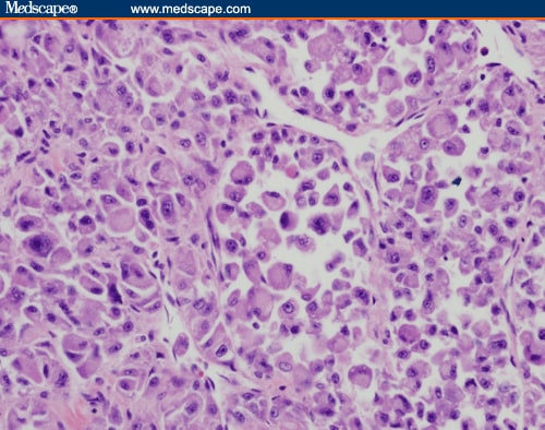 Renal Mass; Orbital Lesion