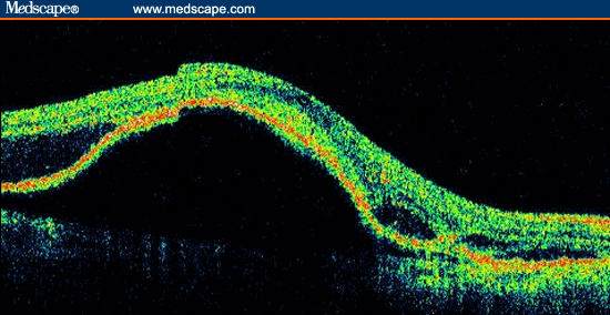Treatment Strategies for AMD: A Review of 3 Clinical Case Presentations