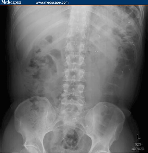 Management of Chronic Constipation in an Elderly Patient in LTC