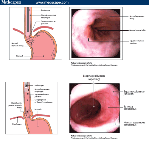 case study 7 gastroesophageal reflux disease