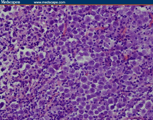 Poorly Differentiated Carcinoma of Unknown Primary Involving the Axilla