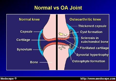osteoarthritis medscape