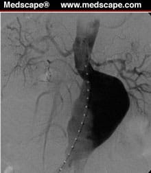 Abdominal Aortic Aneurysm: Screening for a Silent Threat