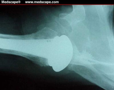 Shoulder Replacement
