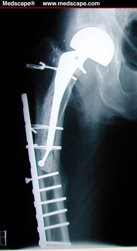 Periprosthetic Fractures of the Femur