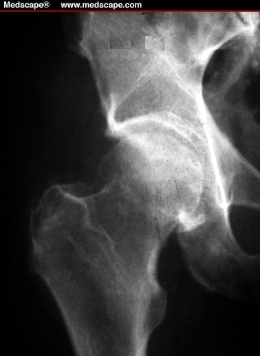 Femoral Neck Fractures