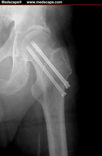 Femoral Neck Fractures