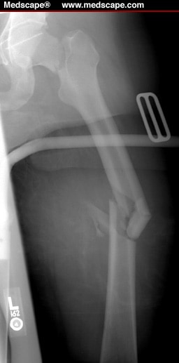 displaced right femoral neck fracture