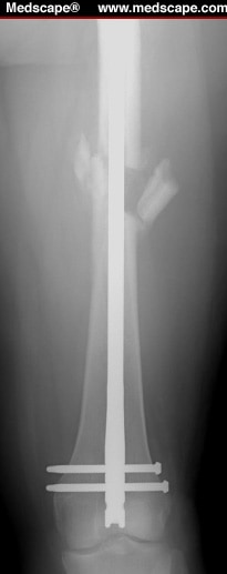 Femoral Neck Fractures - 