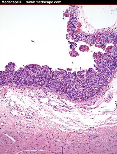 Intestinal Transplantation