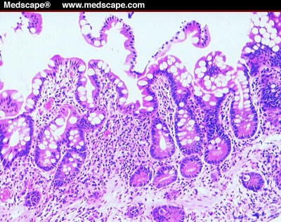 Intestinal Transplantation