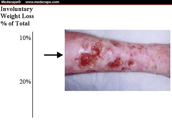 Protein-Energy Malnutrition, and the Nonhealing Cutaneous ...